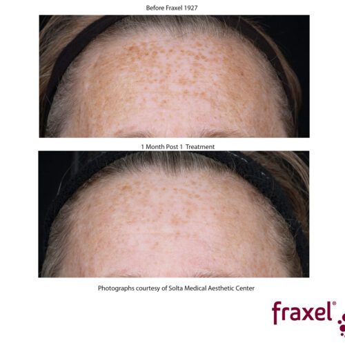 Fraxel-Forehead-0766-Fraxel1927_HiRes-copy