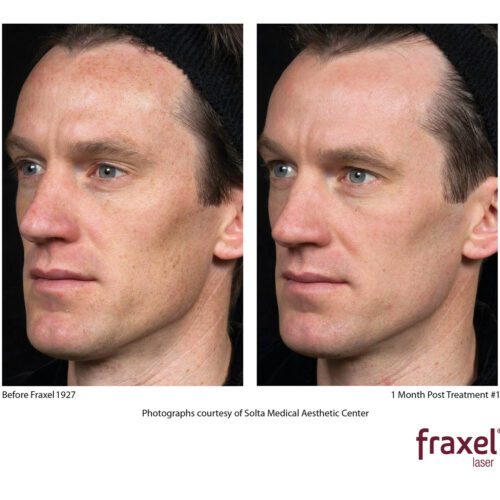 Fraxel-Male-0405-Fraxel_1927_HiRes-copy